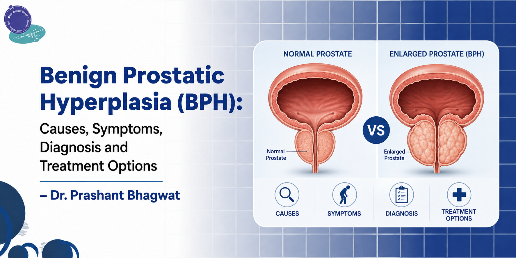 Medical infographic comparing a normal prostate with an enlarged prostate caused by Benign Prostatic Hyperplasia (BPH), highlighting causes, symptoms, diagnosis, and treatment options.